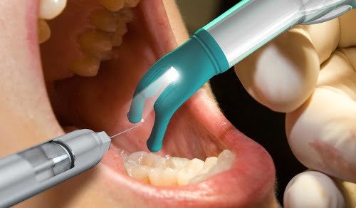 Cấy ghép implant có đau không? Chuyên gia giải đáp 3 Cấy ghép implant có đau không? Chuyên gia giải đáp 3