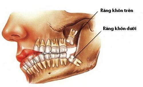 Răng khôn bị nhiễm trùng - Dấu hiệu - Cách điều trị 2