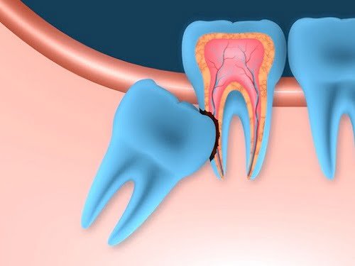 Răng khôn bị nhiễm trùng - Dấu hiệu - Cách điều trị 3