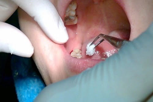 Răng khôn bị nhiễm trùng - Dấu hiệu - Cách điều trị 4