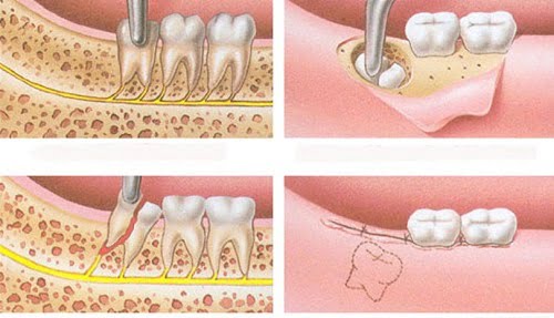 4 răng khôn mọc lệch - Cách xử lý hiệu quả 2