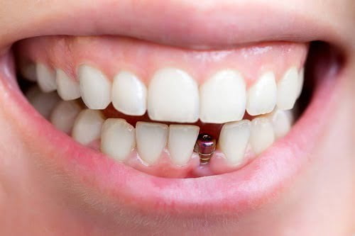 Cấy ghép implant cho răng cửa - Quy trình thực hiện 2