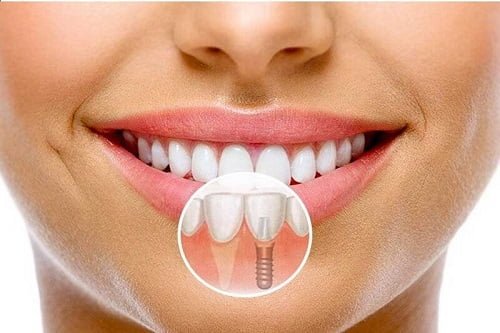 Cấy ghép implant cho răng cửa - Quy trình thực hiện 3