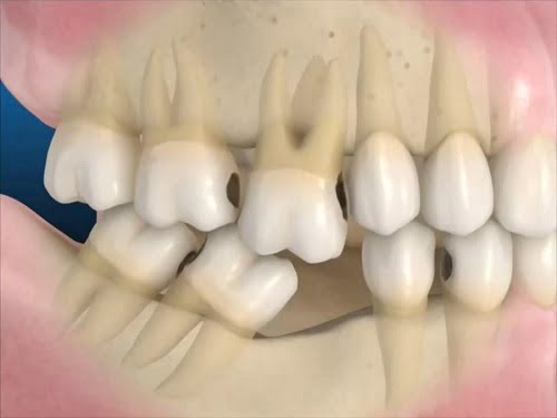Trồng răng giả mất bao lâu với từng phương pháp? 1 Trồng răng giả mất bao lâu với từng phương pháp? 1