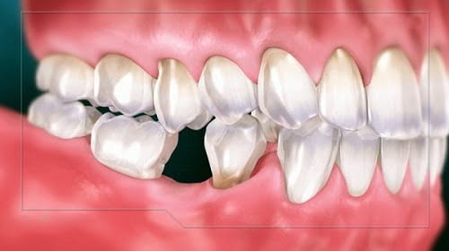 Trồng răng sứ có tốt không? Có đảm bảo không? 1 Trồng răng sứ có tốt không? Có đảm bảo không? 1