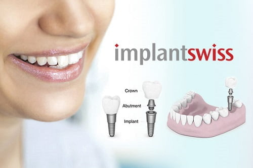 Chăm sóc răng sau khi cấy implant - Hướng dẫn từ nha khoa 1