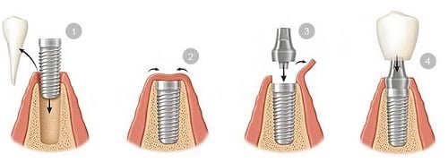 Chăm sóc răng sau khi cấy implant - Hướng dẫn từ nha khoa 2