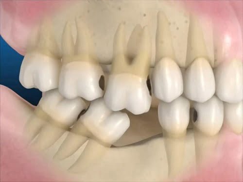 Nên bọc răng sứ hay cấy ghép implant - Nha khoa tư vấn 1