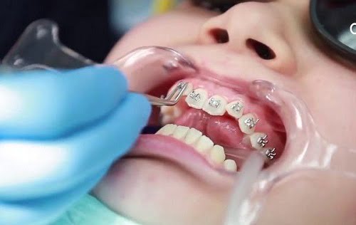 Niềng răng lúc nào đau nhất? Tìm hiểu quy trình 2 Niềng răng lúc nào đau nhất? Tìm hiểu quy trình 2