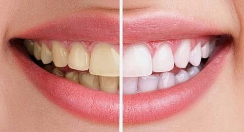 Tẩy trắng răng có ảnh hưởng gì không? Tìm hiểu chi tiết 2