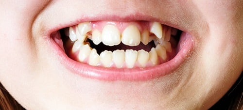 Niềng răng lộn xộn - Giải pháp thẩm mỹ cho khuôn hàm 1 Niềng răng lộn xộn - Giải pháp thẩm mỹ cho khuôn hàm 1