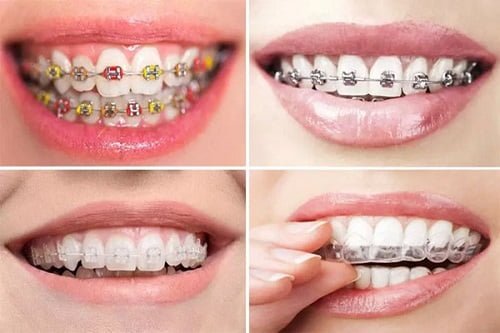 Niềng răng lộn xộn - Giải pháp thẩm mỹ cho khuôn hàm 2