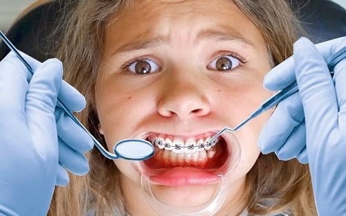 Niềng răng xong bị móm - Nguyên nhân chính 2 Niềng răng xong bị móm - Nguyên nhân chính 2