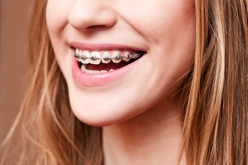 Niềng răng xong có nên tẩy trắng răng? Giải đáp lý do 1