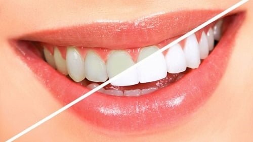 Niềng răng xong có nên tẩy trắng răng? Giải đáp lý do 2