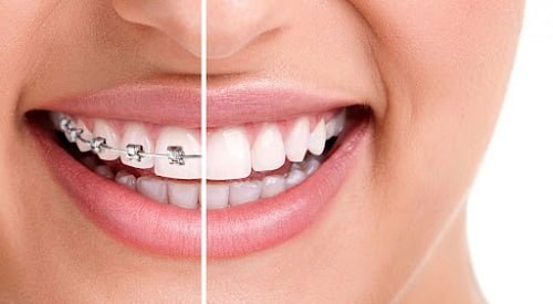 Niềng răng xong có nên tẩy trắng răng? Giải đáp lý do 3