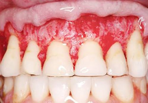 Tác hại của việc tẩy trắng răng bạn đã biết? 2