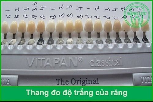 Tẩy trắng răng bằng đèn plasma giá bao nhiêu? Có rẻ không? 3 Tẩy trắng răng bằng đèn plasma giá bao nhiêu? Có rẻ không? 3