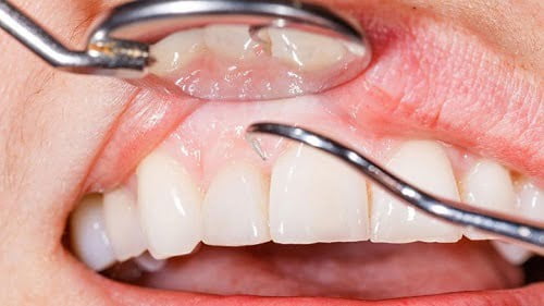 Tẩy trắng răng plasma có hại không? Tham khảo từ nha khoa 3