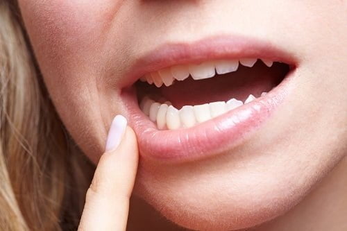 Nhổ 2 răng khôn hàm trên một lần có nên không? 1