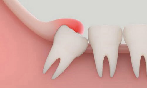 Sưng lợi ở răng khôn - Cách điều trị hiệu quả 1 Sưng lợi ở răng khôn - Cách điều trị hiệu quả 1