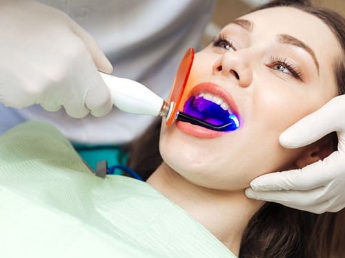 Tẩy trắng răng bằng đèn plasma có hại không? Tìm hiểu nhanh 2