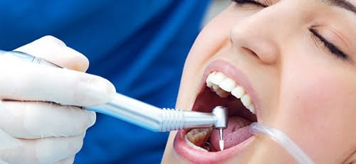 Tẩy trắng răng bằng đèn plasma có hại không? Tìm hiểu nhanh 3