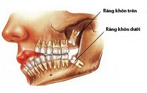 Mọc 4 cái răng khôn cùng lúc gây ảnh hưởng gì? 1