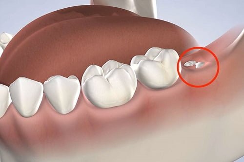 Mọc 4 cái răng khôn cùng lúc gây ảnh hưởng gì? 2
