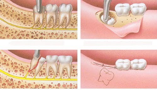 Mọc 4 cái răng khôn cùng lúc gây ảnh hưởng gì? 3