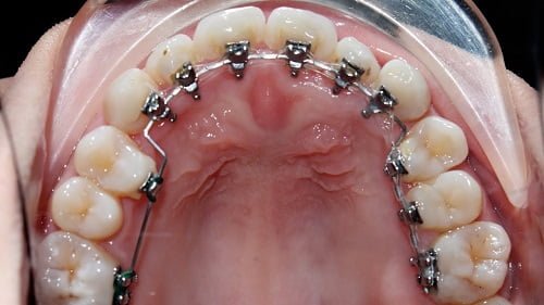 Niềng răng phải nhổ răng nào là hợp lý nhất? 1