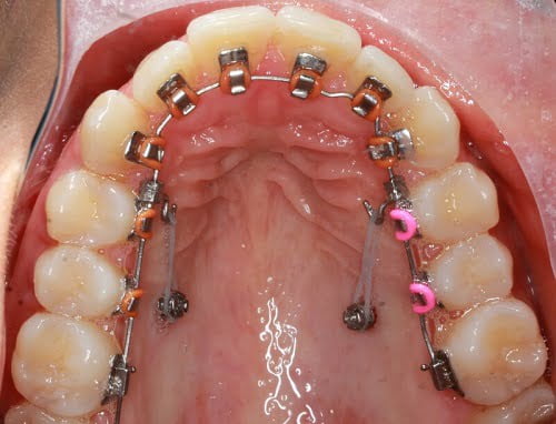 Niềng răng phải nhổ răng nào là hợp lý nhất? 2