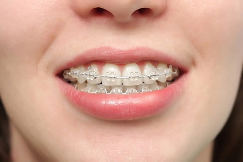 Niềng răng phải nhổ răng nào là hợp lý nhất? 3