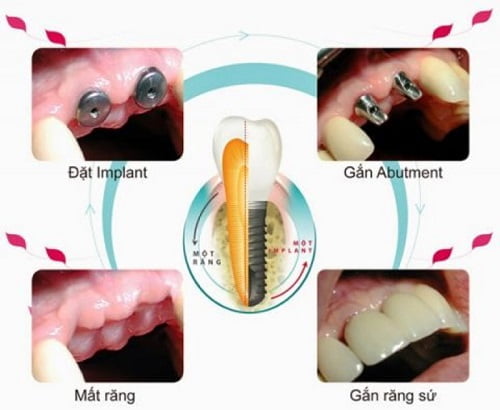 Cấy ghép răng implant ở đâu tốt bền đẹp? 2