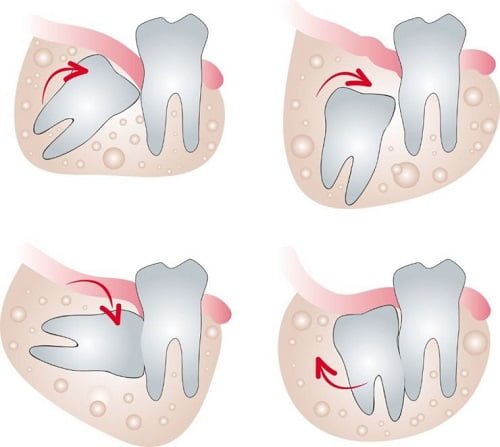 Răng khôn bị viêm - Triệu chứng - Cách khắc phục 1