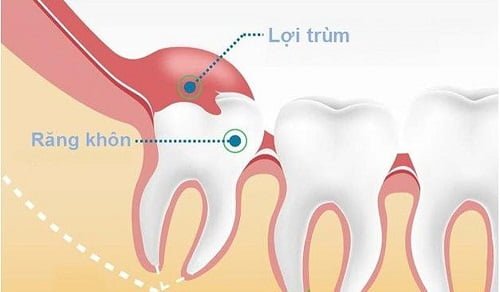 Răng khôn bị viêm - Triệu chứng - Cách khắc phục 2