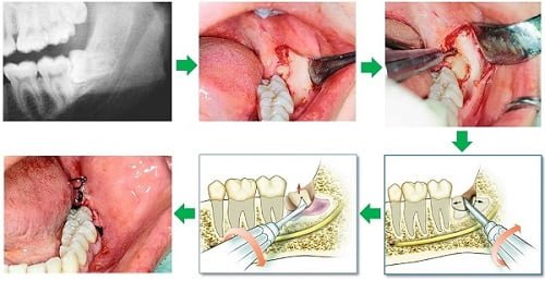 Răng khôn bị viêm - Triệu chứng - Cách khắc phục 3