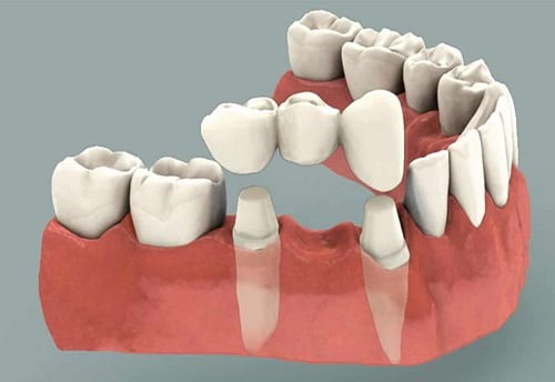 Trồng răng bằng cầu răng - Giải pháp cho bạn 1