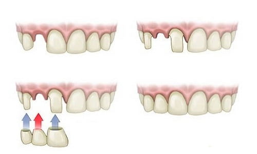 Trồng răng bằng cầu răng - Giải pháp cho bạn 2