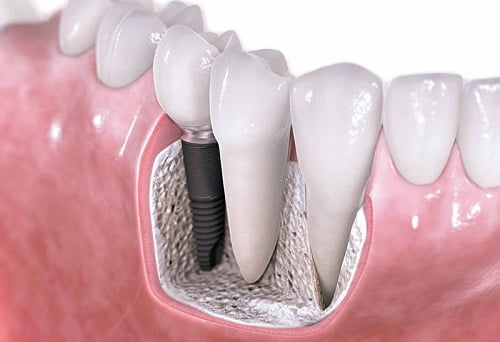 Trồng răng hàm implant giá bao nhiêu? Giá mới nhất 1