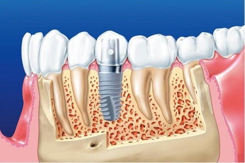 Trồng răng implant có đau không? Tìm hiểu cách thực hiện 1 Trồng răng implant có đau không? Tìm hiểu cách thực hiện 1