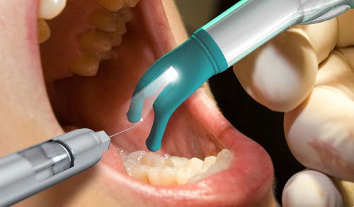 Trồng răng implant có đau không? Tìm hiểu cách thực hiện 2