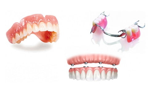 Trồng răng giả loại nào tốt nhất? Tham khảo tư vấn 1 Trồng răng giả loại nào tốt nhất? Tham khảo tư vấn 1