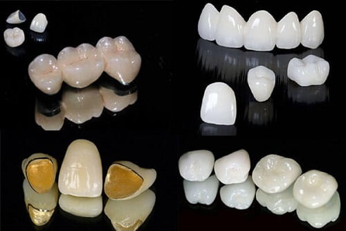 Trồng răng giả loại nào tốt nhất? Tham khảo tư vấn 2