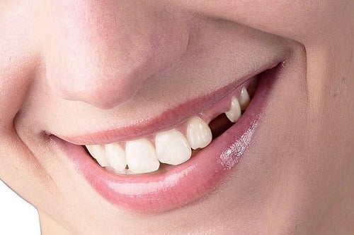 Mất răng lâu năm có trồng được không? Chuyên gia giải đáp 1 Mất răng lâu năm có trồng được không? Chuyên gia giải đáp 1