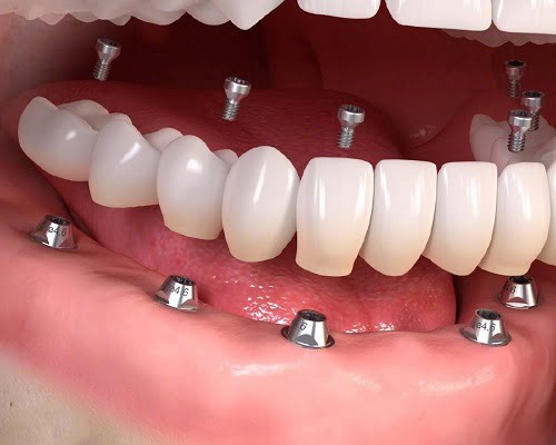 Kinh nghiệm làm răng implant hữu ích cho bạn 1
