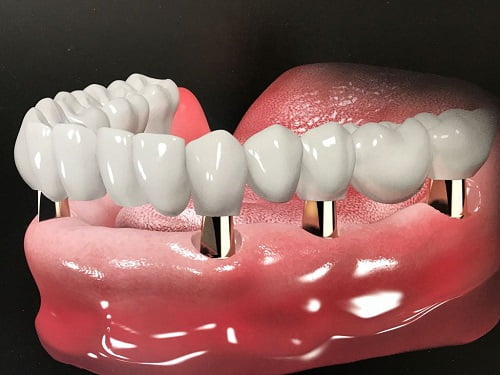 Kinh nghiệm làm răng implant hữu ích cho bạn 2