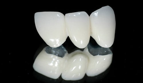 Có nên trồng răng sứ kim loại không? Giải đáp 1 Có nên trồng răng sứ kim loại không? Giải đáp 1